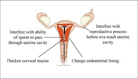 emergency contraception copper IUD